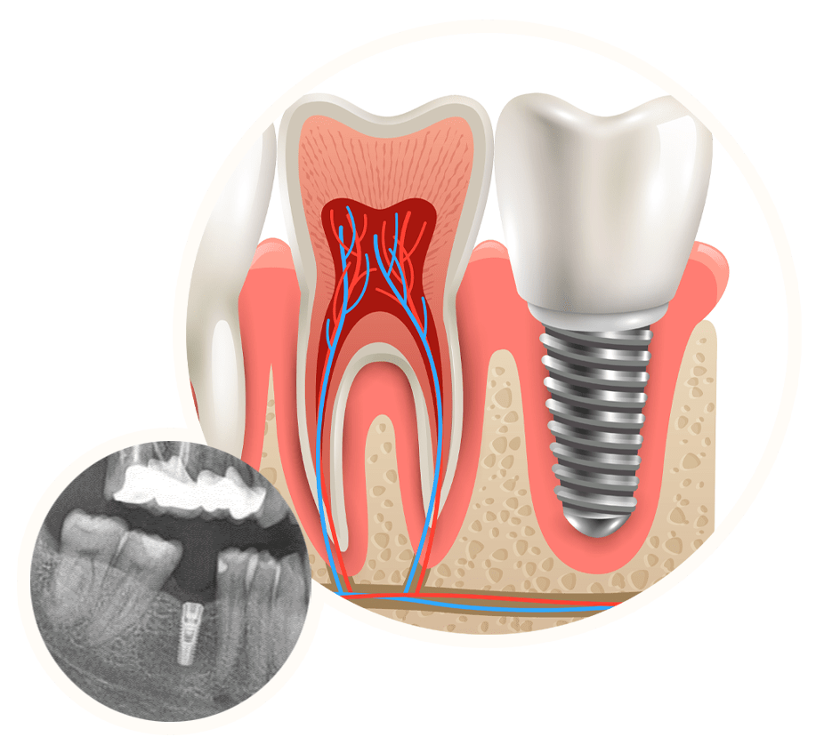 Implantáció, szájsebészet Szekszárd Mosolyrendelő, Dr. Kerner László.